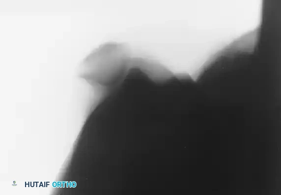 صورة أشعة بوضعية شروق الشمس تظهر انزياح الصابونة للخارج وتوضح خطر تعرض الغضروف للإصابة